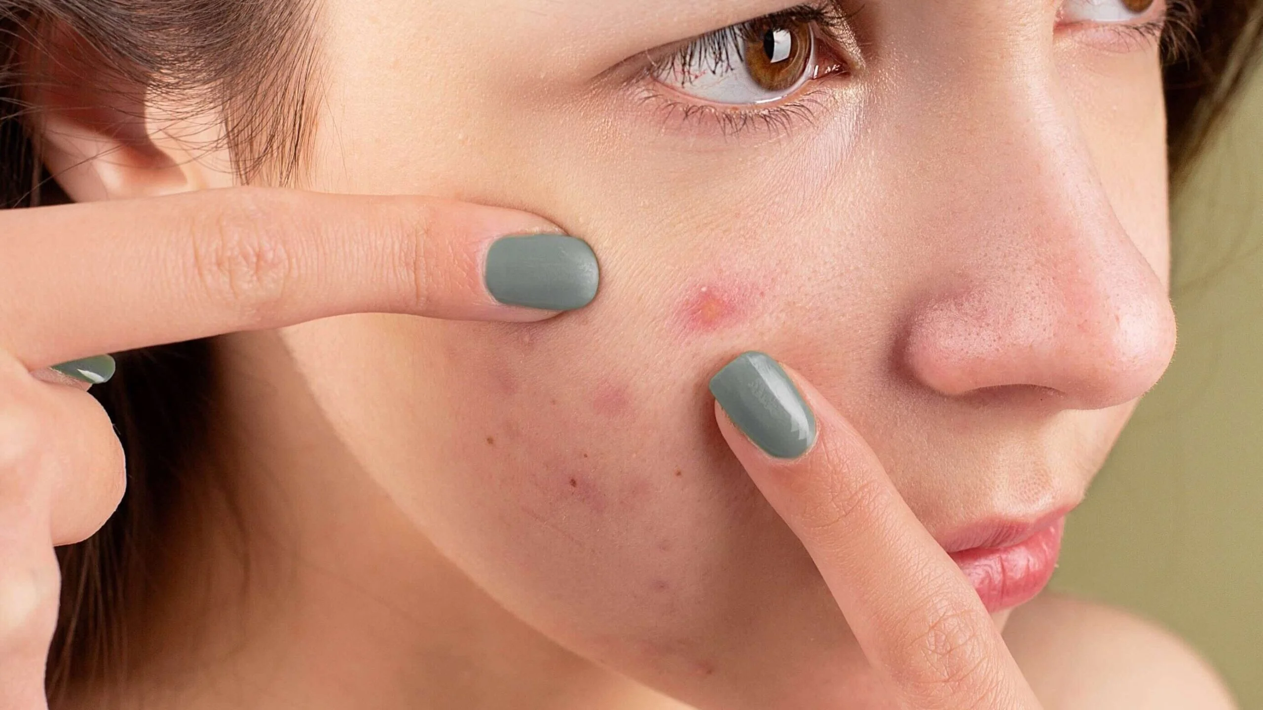 Cures acne